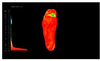 3D Printing Patient-Specific Foot Orthoses
