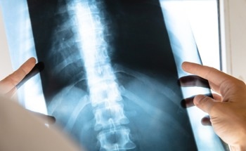 Treating Spinal Cord Injuries Using a Chitosan Hydrogel with Dopamine