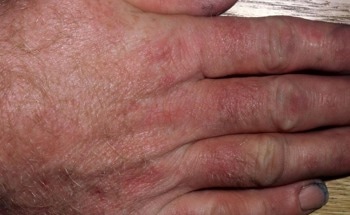 New Epoxy Resin Monomer That is Less Allergenic