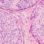 Single Molecule Arrays for Analyzing Tumor Cells