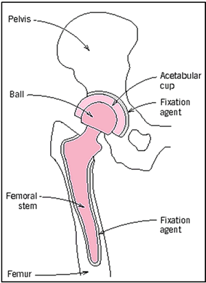 AZoJoMo – AZoM Journal of Materials Online - Schematic of an artificial THR.