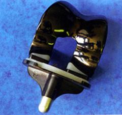 AZoM - Metals, Ceramics, Polymer and Composites : Titanium Nitride Coated Titanium Implants – Improving Performance of Implants Using Surface Coatings - diamond-like carbon coating on knee implant